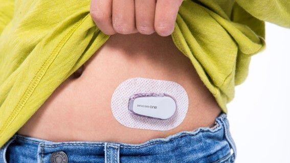 Dexcom sensors tiek nēsāts uz vēdera